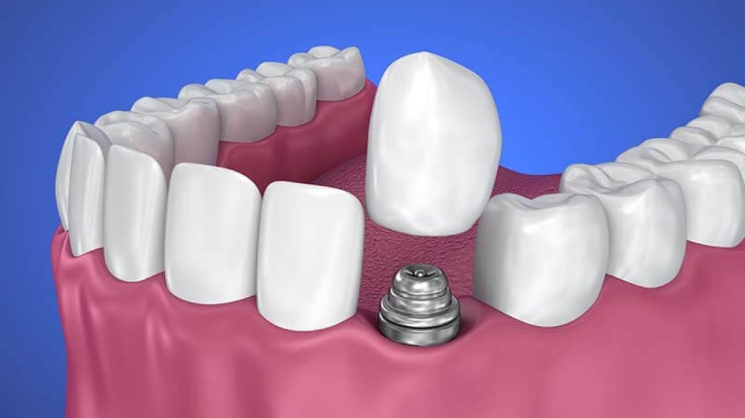 Albion Family Dental : Crown Implants in Albion | (585) 589-9044