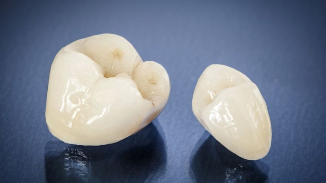 Veneto Dental Care : Dental Crowns in Miramar, FL