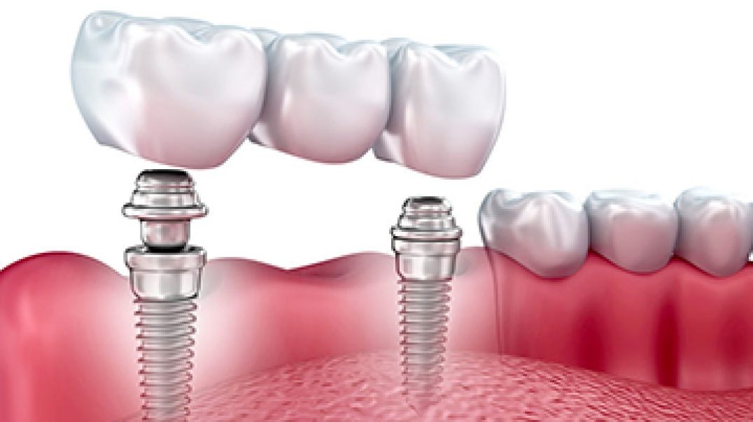 Advanced Dentistry of Coral Springs : #1 All ON 4 Dental Implants in Coral Springs, FL