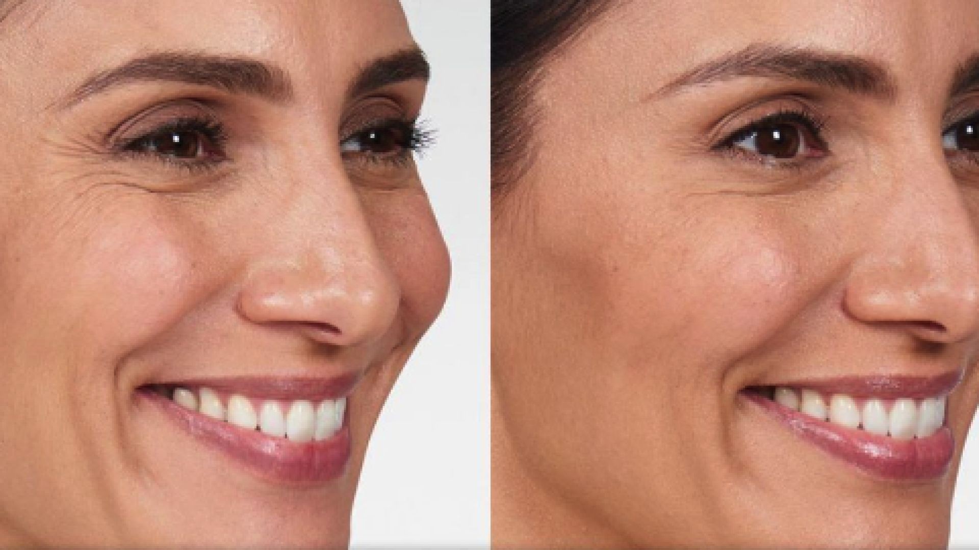 Advanced Dental Solutions : Botox in Sunset, FL